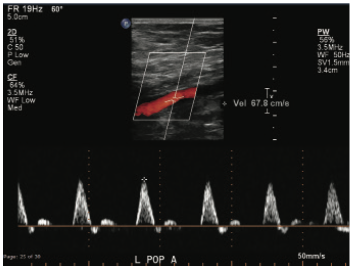 Beasley-Yates MicroMedical Stent Figure 2