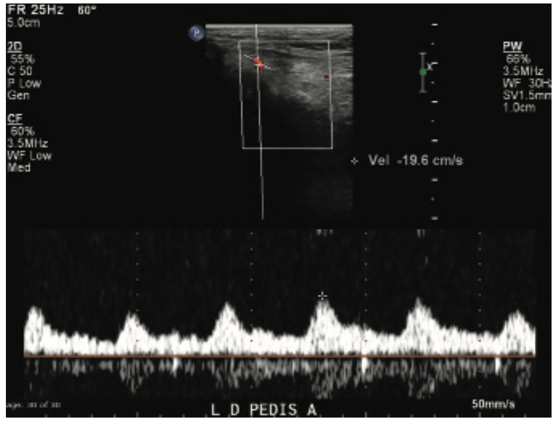 Beasley-Yates MicroMedical Stent Figure 3
