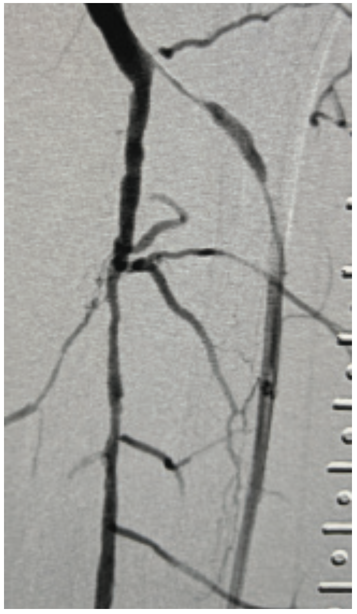 Beasley-Yates MicroMedical Stent Figure 4