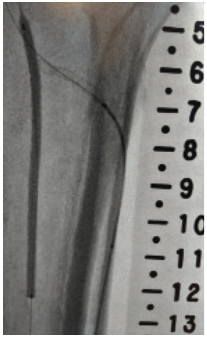 Beasley-Yates MicroMedical Stent Figure 5