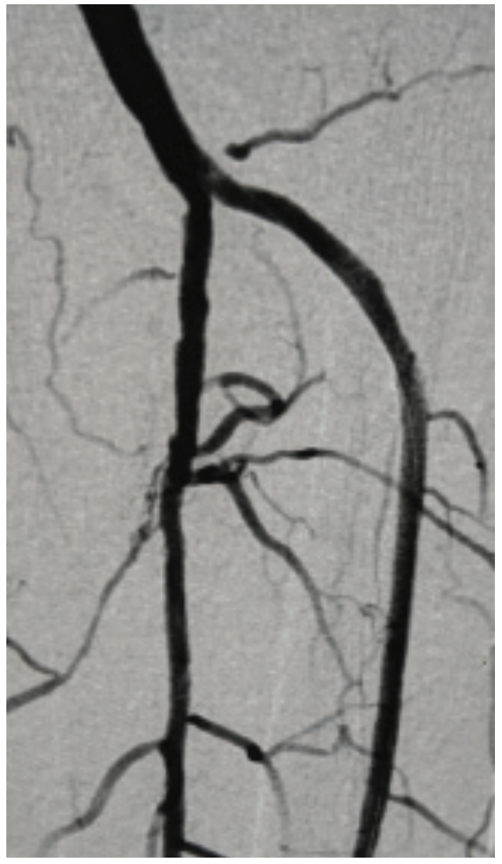 Beasley-Yates MicroMedical Stent Figure 6