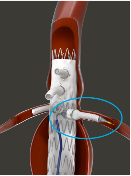 The Bentley BeFlared: the first dedicated bridging stent for complex FEVAR interventions, allowing precise deployment in one step.
