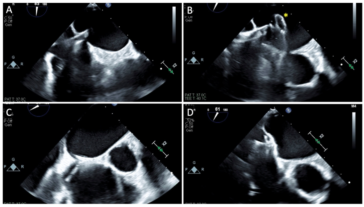 Bernstein Atrial Septal Defect Figure 1