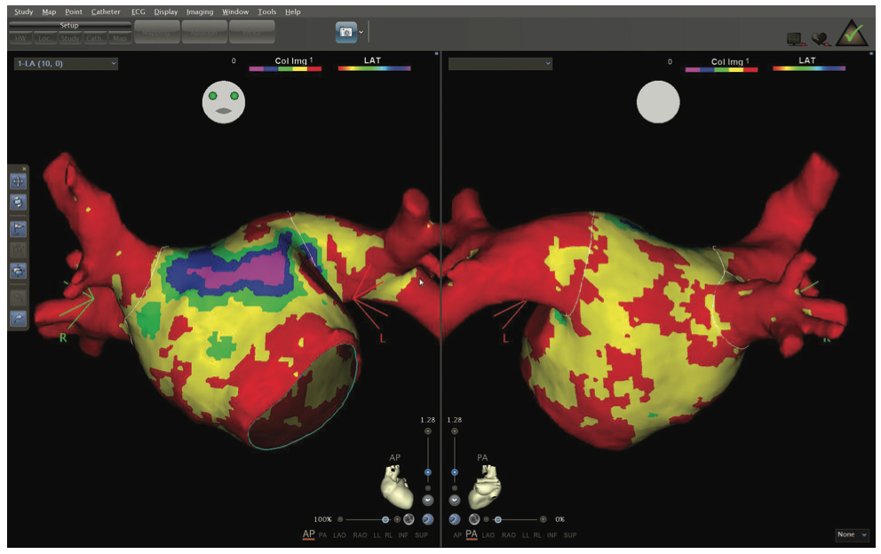 Berruezo AFib Figure 1