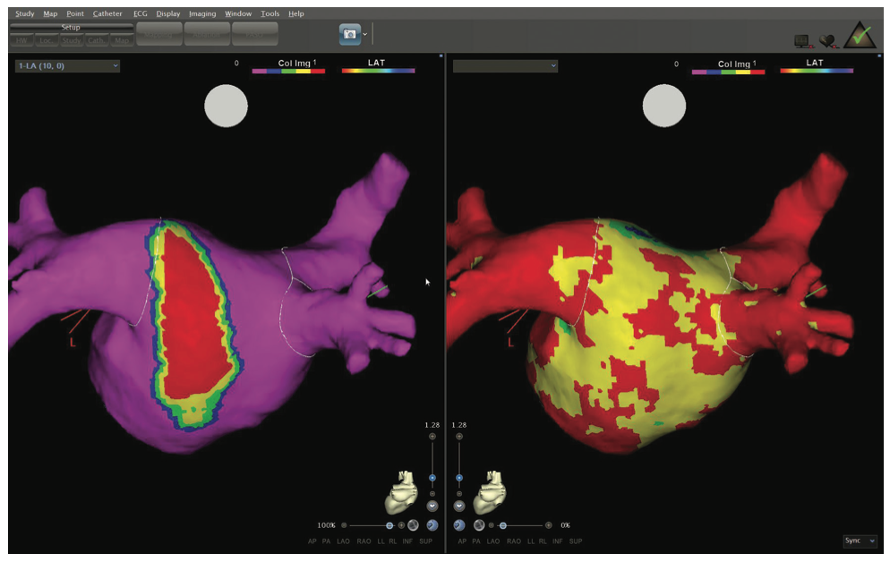 Berruezo AFib Figure 2