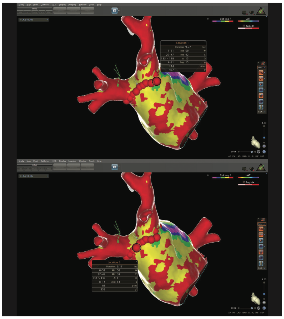 Berruezo AFib Figure 5-6