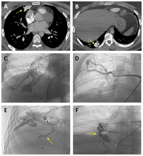 Figure. Thoracic computed tomographic angiography 