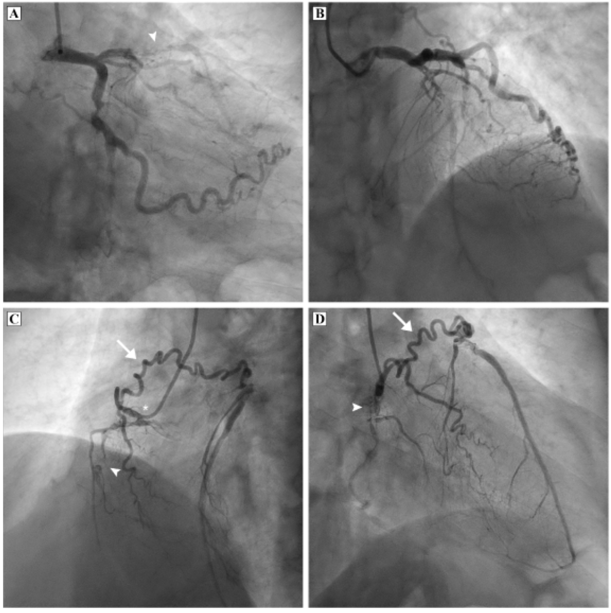 Bhasin Vieussens’ Arterial Ring Figure 1