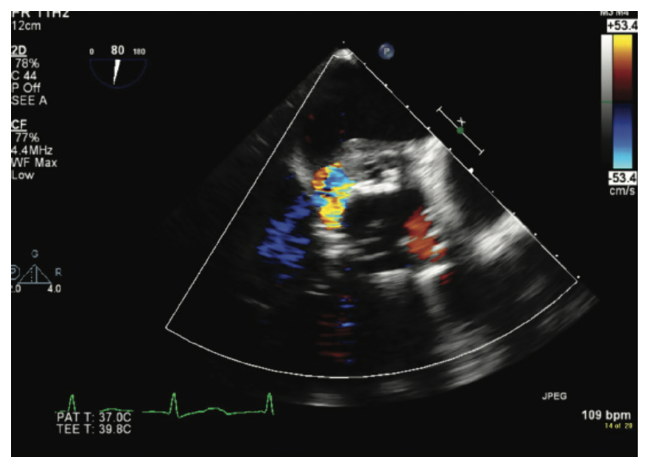 Bhattad Aortic Root Abscess Figure 7