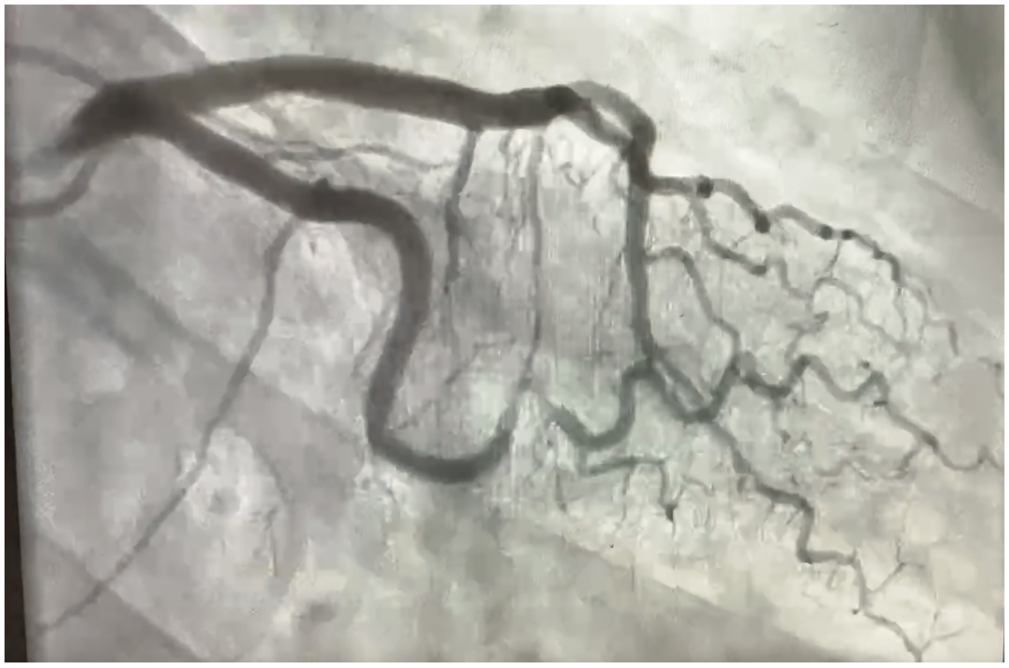 Bhattad Artery Dissection Figure 1