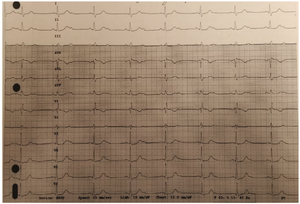 Bhattad Atrioventricular Figure 1