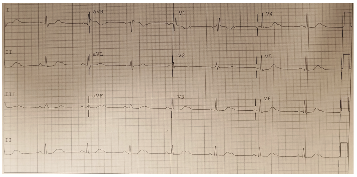 Bhattad Atrioventricular Figure 2