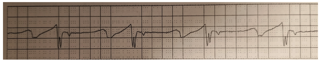 Bhattad Atrioventricular Figure 3