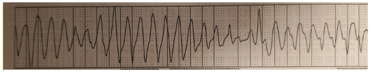 Bhattad Atrioventricular Figure 4
