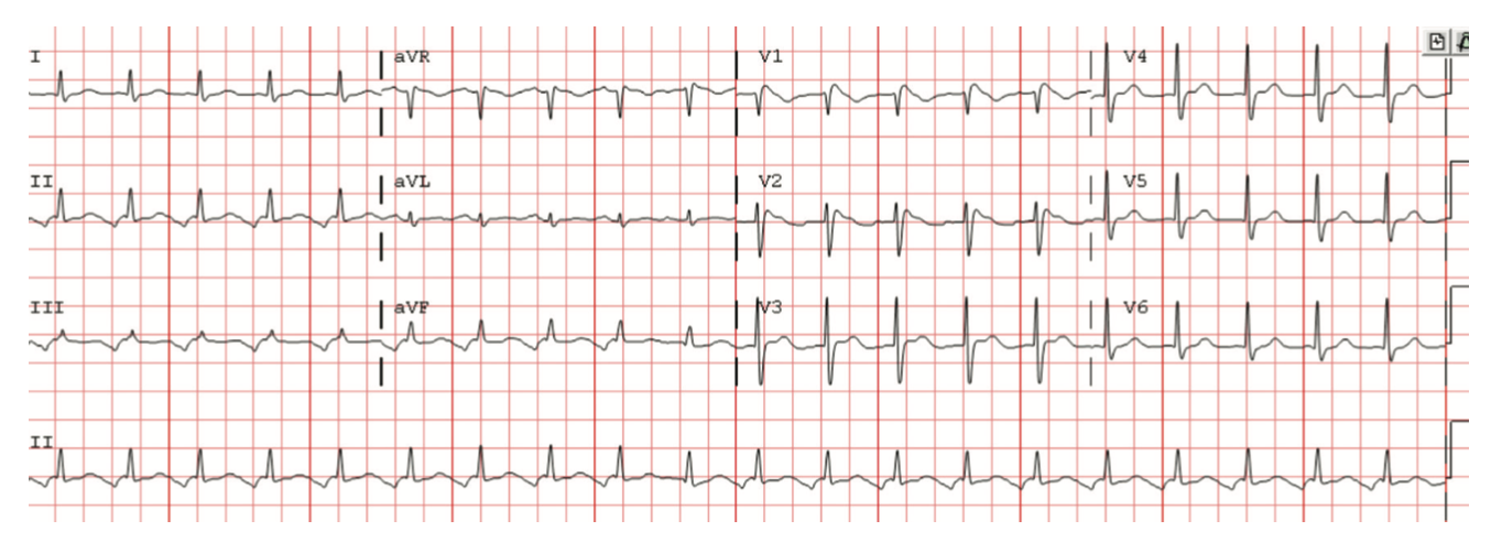 Bhattad Brugada Figure 1