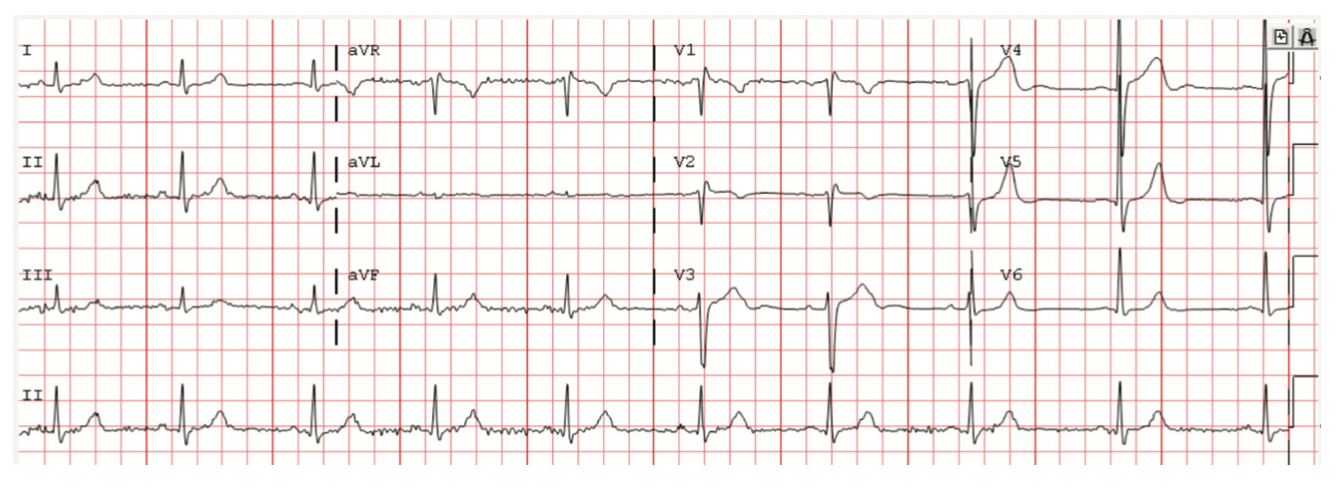 Bhattad Brugada Figure 2