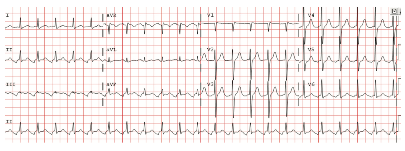 Bhattad Brugada Figure 3