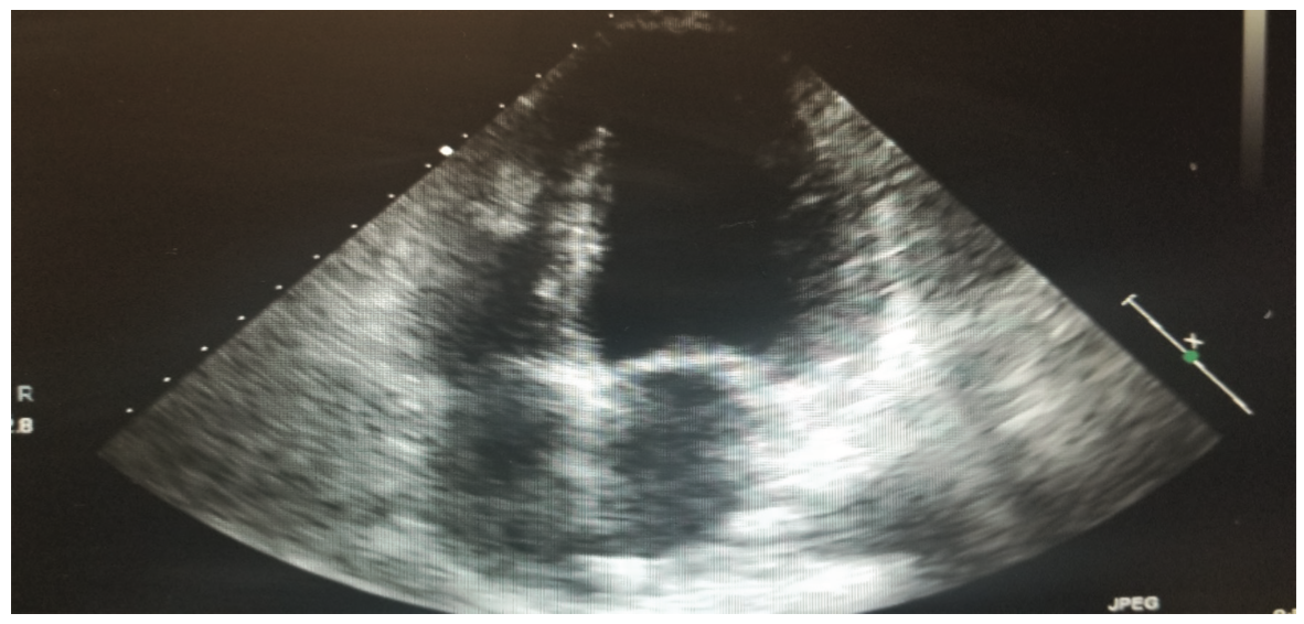 Bhattad Cardiac Rhabdomyoma Figure 1