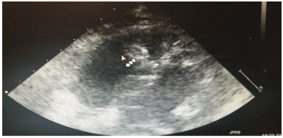 Bhattad Cardiac Rhabdomyoma Figure 2