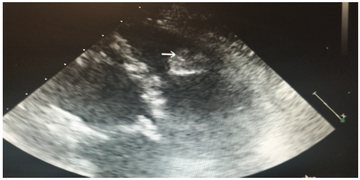Bhattad Cardiac Rhabdomyoma Figure 3
