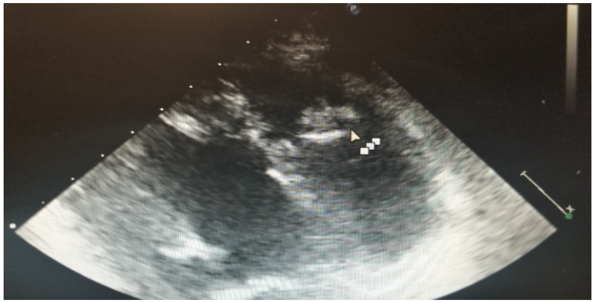 Bhattad Cardiac Rhabdomyoma Figure 4
