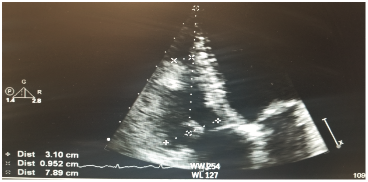 Bhattad Cardiac Rhabdomyoma Figure 5