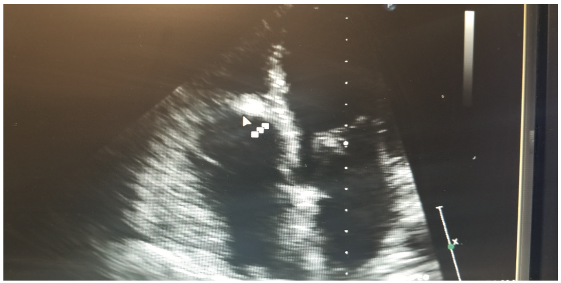 Bhattad Cardiac Rhabdomyoma Figure 6