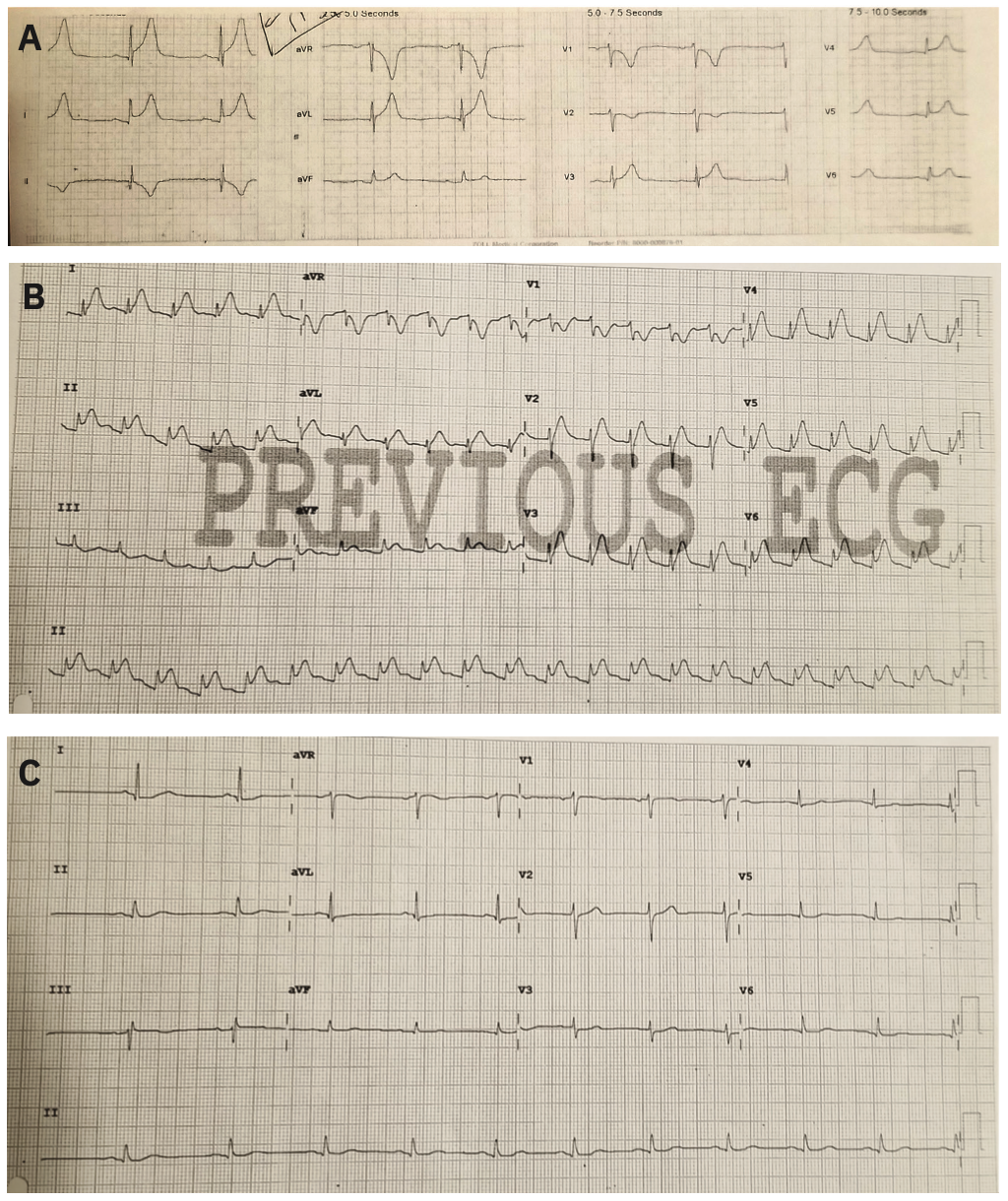 Bhattad Coronary Vasospasm Figure 1