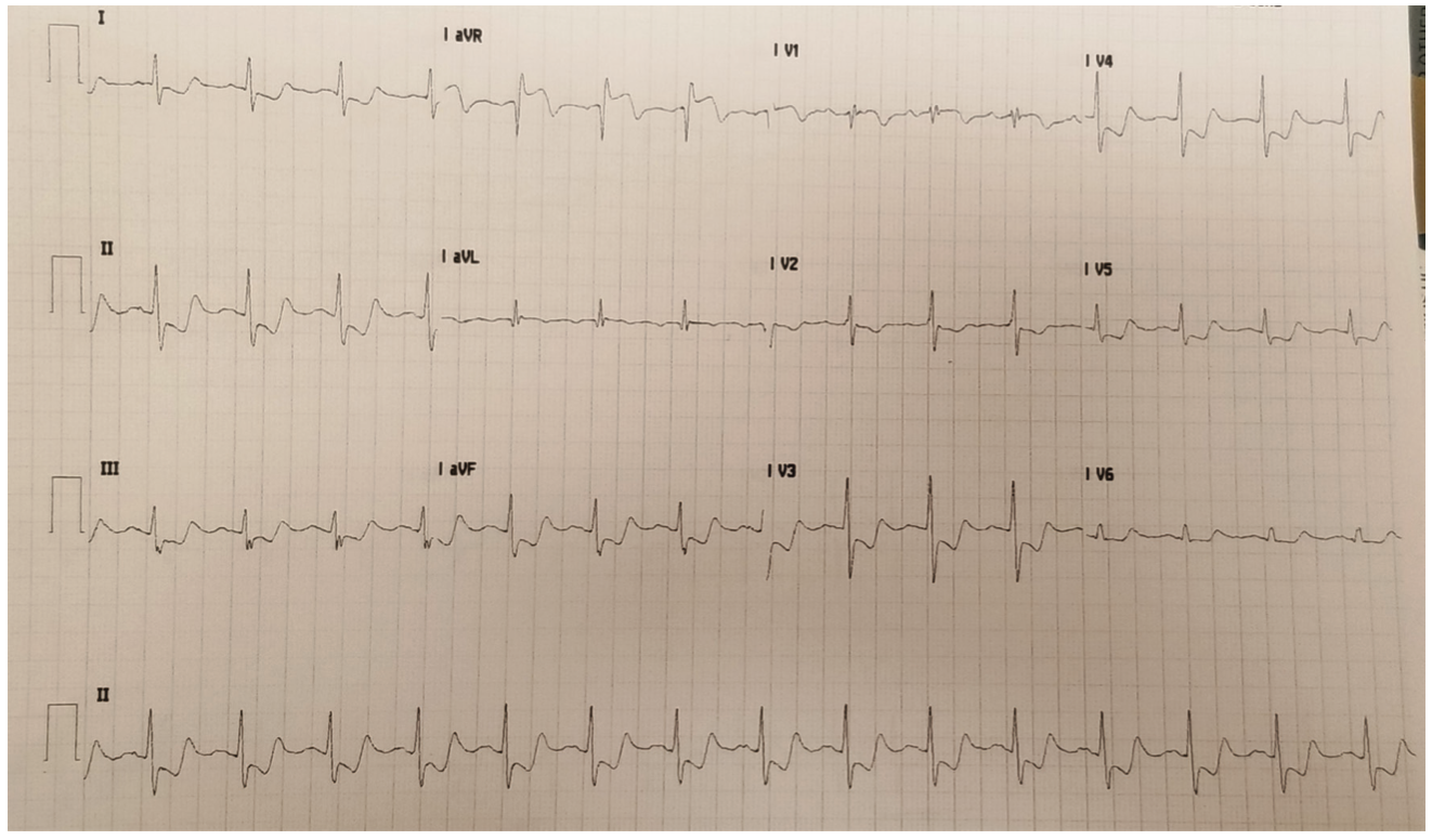 Bhattad Subendocardial Figure 1
