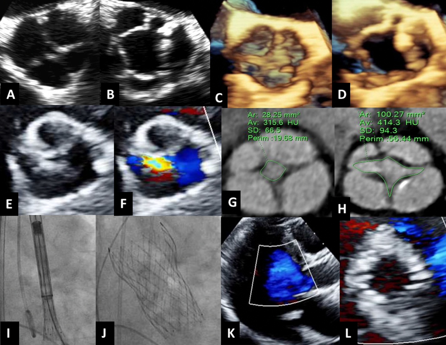 Figure. Successful TAVR implant