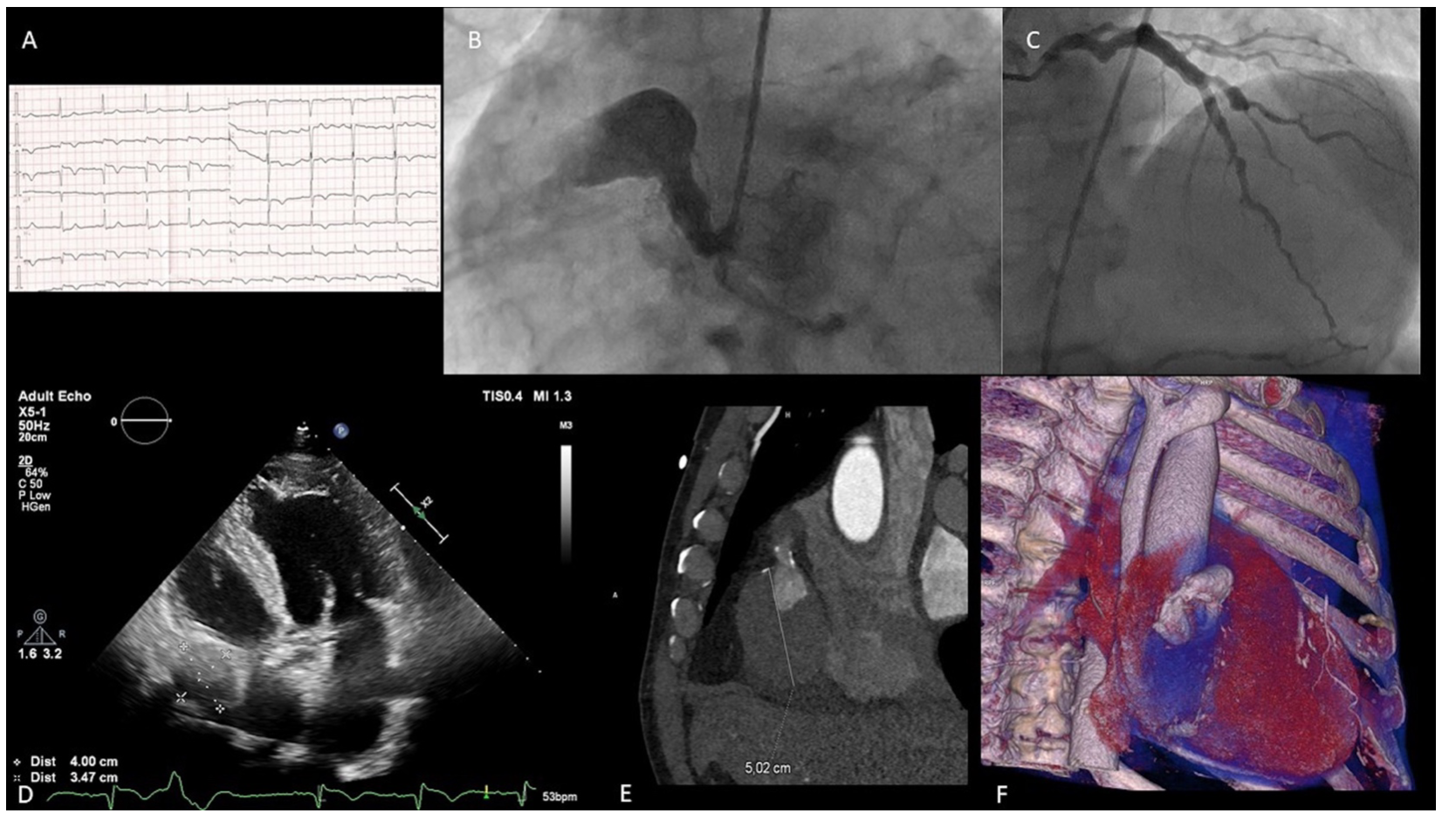 Bochenek Myocardial Infarction Figure 1