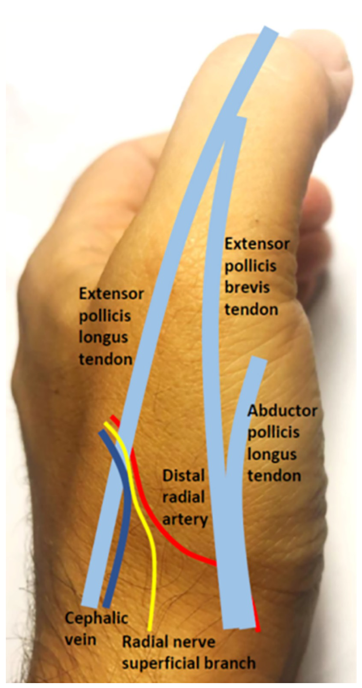 Bompotis Radial Artery Access Figure 1