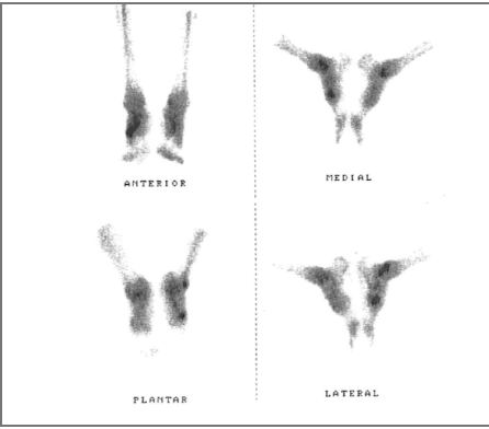 A technetium-99m magnesium diphosphonate (MDP) bone scan may show uptake in the soft tissue angiogram phase, representing increased blood flow and thus inflammation secondary to hypermobility.
