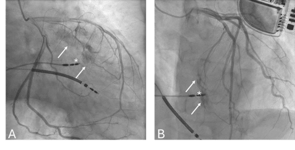 Figure. Coronary angiography
