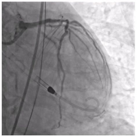 Figure 1. Subtotal proximal circumflex (Cx) lesion and severe diffuse calcium in the left anterior descending (LAD).