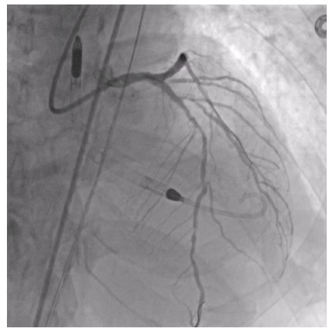 Figure 2. Subtotal proximal Cx lesion and severe diffuse calcium in the LAD.