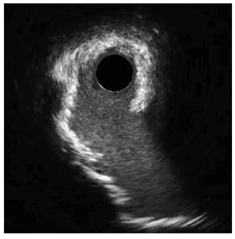 Figure 3. Pre-treatment Cx intravascular ultrasound (IVUS).