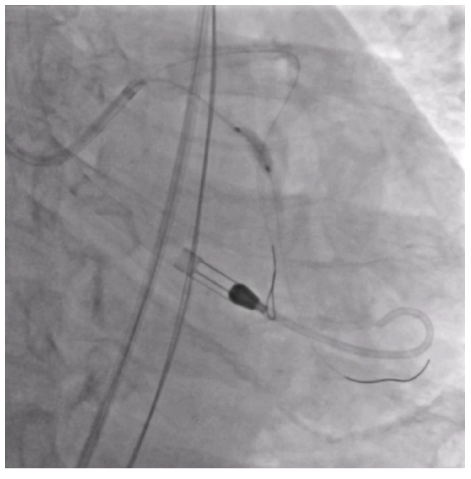 Figure 4. Cx treatment with a 4.0 mm  Shockwave C2 Aero.
