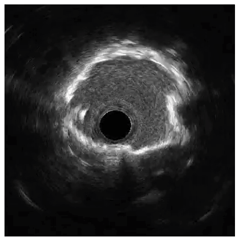 Figure 5. Post-stent Cx IVUS.