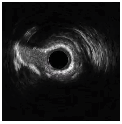 Figure 6. Pre-treatment LAD IVUS.