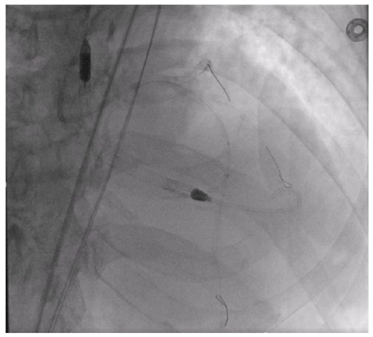 Figure 7. Rewrapped Shockwave C2 Aero delivering through the diffuse LAD calcification.