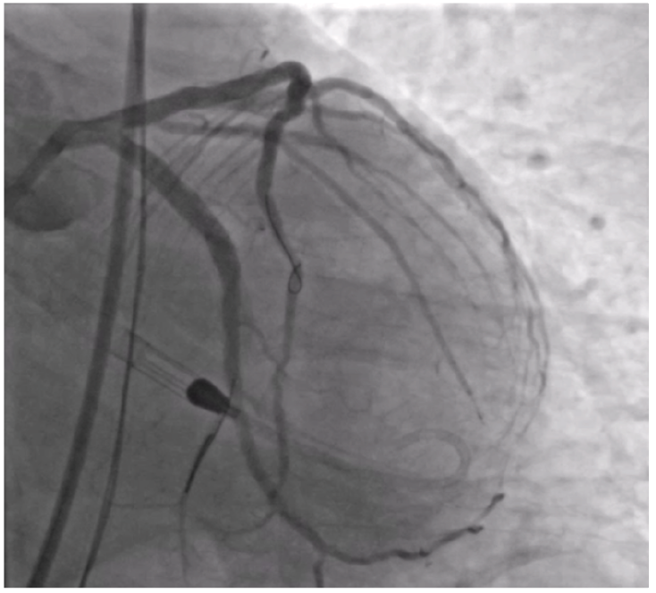 Figure 8. Final angiogram.