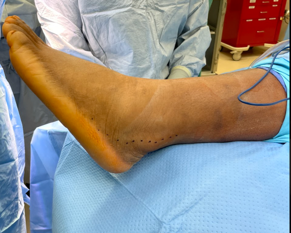 Peroneal Tendon Pathology