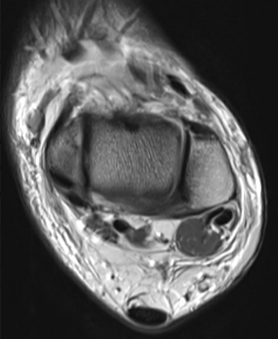 Coronal MRI