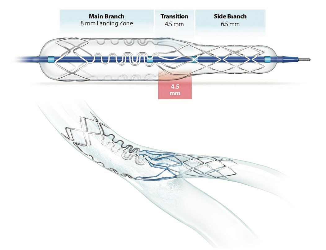 Byers Corindus Figure 2
