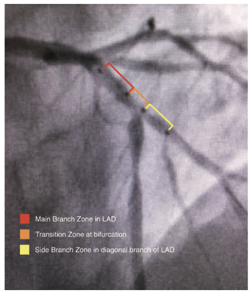 Byers Corindus Figure 5