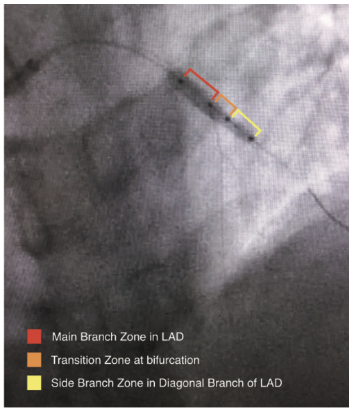 Byers Corindus Figure 6