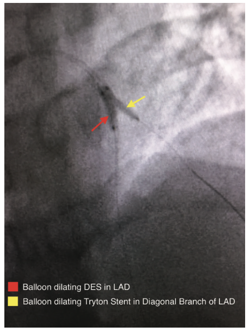 Byers Corindus Figure 8