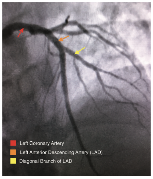 Byers Corindus Figure 9