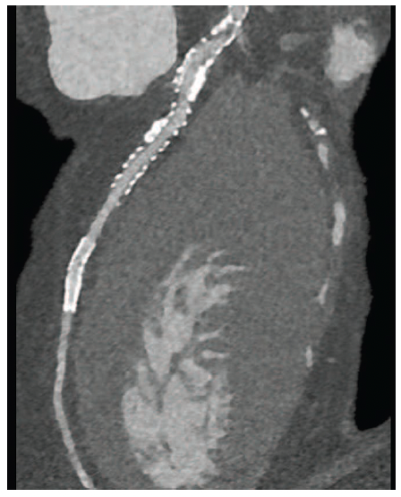 Figure 1. Left anterior descending artery (LAD) curved planar reformat (CPR).